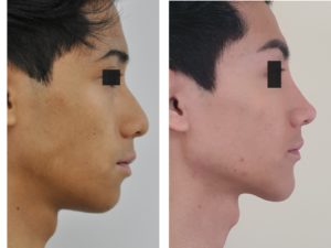 Dermal filler to lift nasal tip , build nasal bridge , give forward projection to jaw and define jawline angle near the ear