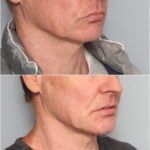 Male Dermal FIller Chin and mouth support