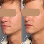 Male left oblique view chin projection with dermal filler in cleft chin