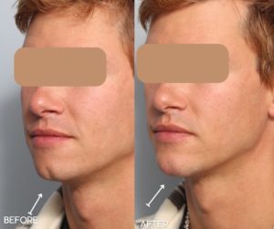 Male left oblique view chin projection with dermal filler in cleft chin