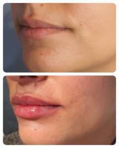 left oblique lip close up m shape correction