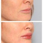 Female oblique view lip filler