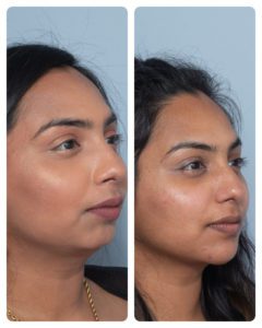 right oblique chin filler female