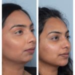 Right oblique chin projection with dermal filler