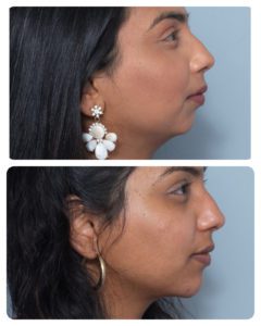 Profiler female chin filler