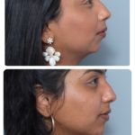 Right side profiler chin filler female